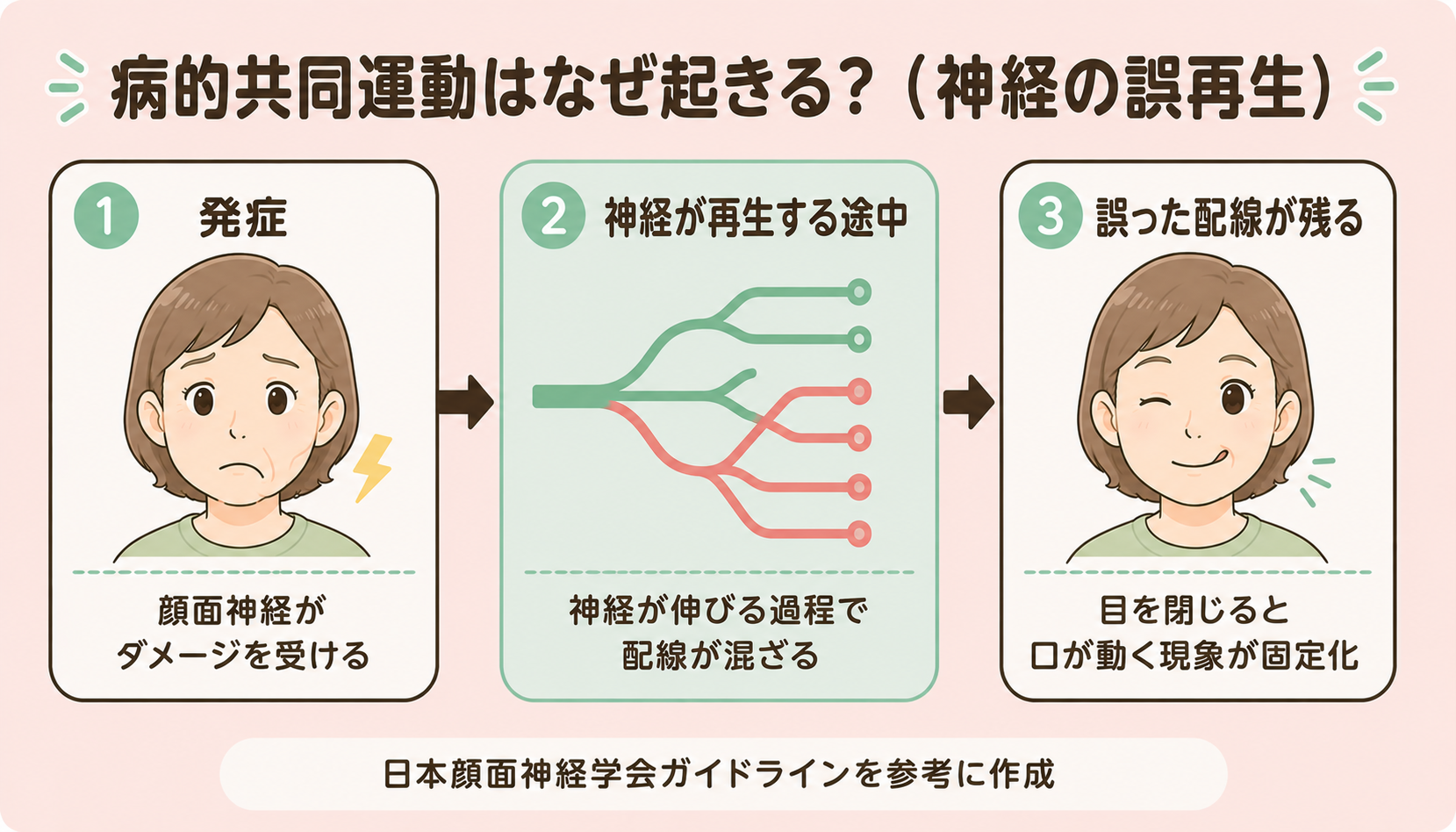 病的共同運動が起きる仕組み：神経の誤再生（日本顔面神経学会ガイドラインを参考に作成）