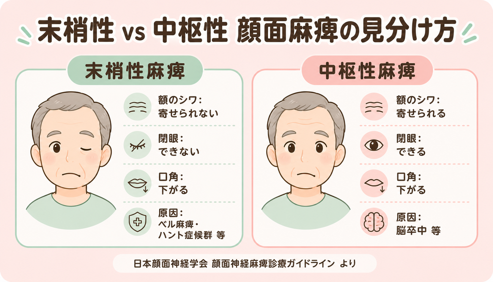 末梢性顔面麻痺と中枢性顔面麻痺の見分け方：額のシワ・閉眼・口角の違いを示す比較図（日本顔面神経学会ガイドラインより）